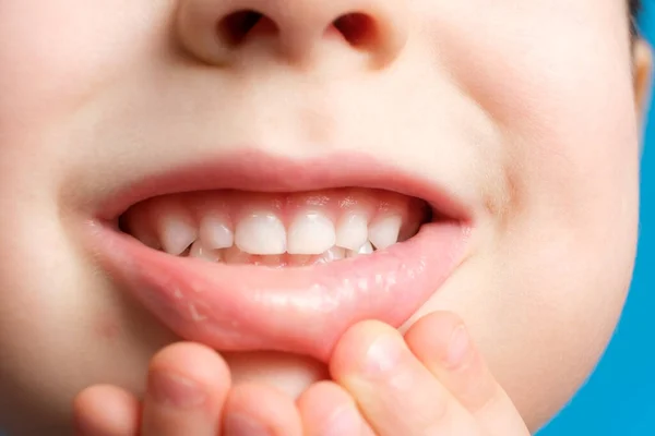Dentes de leite de crianças em uma criança, boca aberta, close-up. Odontologia pediátrica, esmalte desbastado — Fotografia de Stock