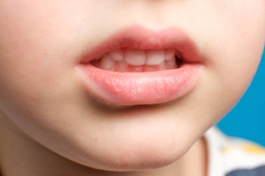 Çocuktaki süt dişleri, ağzı açık, yakın plan. Pediatrik dişçilik, inceltilmiş diş minesi.