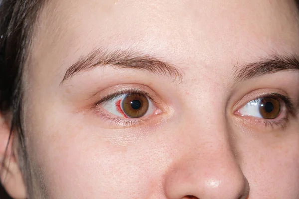 Olhos macro-humanos, capilares estourados, nódoas negras no olho branco. Mancha vermelha após o parto em uma mulher em trabalho de parto, close-up. — Fotografia de Stock