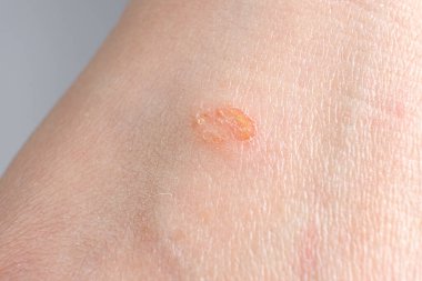 Streptoderma - insan derisinde dermatit, kırmızı yuvarlak nokta, makro fotoğraf, bakteri iltihabı