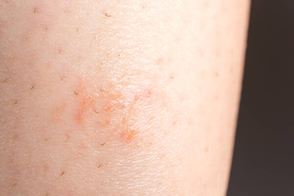 Streptoderma - dermatitis on human skin, red round spot, macro photography, bacterial inflammation