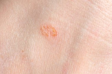 Streptoderma - insan derisinde dermatit, kırmızı yuvarlak nokta, makro fotoğraf, bakteri iltihabı