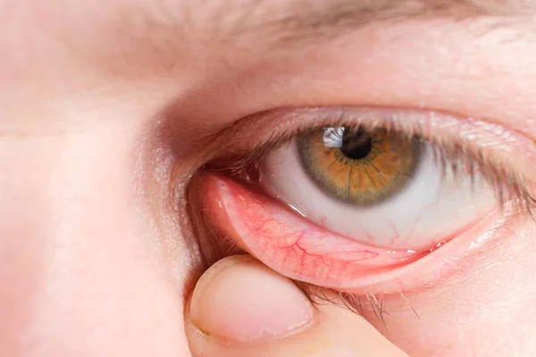 Červené spodní víčko, makro fotografie lidského oka. Zánět spojivek, zánět sliznice oka. — Stock fotografie