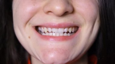Temporomandibular eklem bozukluğu olan bir kadın ağzını açar ve kapatır. Alt çene yana kayar..