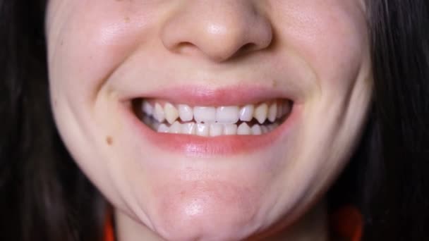 A woman with malocclusion and dysfunction of the temporomandibular joint opens and closes her mouth, the lower jaw shifts to the side. — Vídeo de Stock