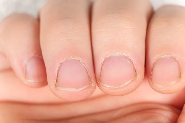 Unkempt uñas masculinas con una cutícula regenerada sobre un fondo blanco — Foto de Stock