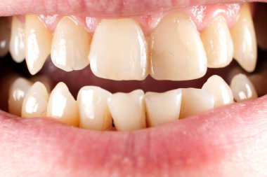 Teeth with tartar and caries, crooked lower foreground incisors, close-up