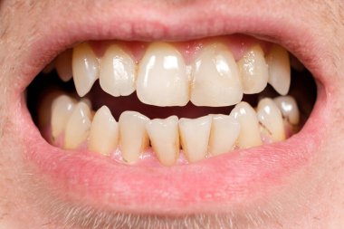 Tartarlı dişler, eğri büğrü ön dişler, yakın plan.