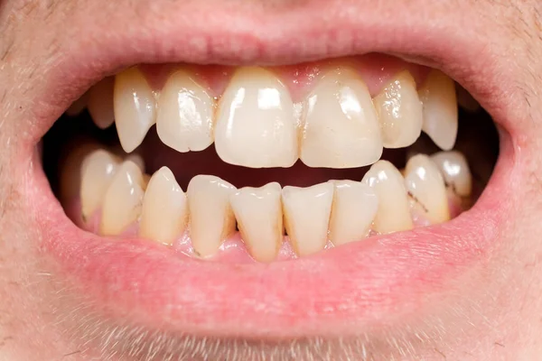 Teeth with tartar and caries, crooked lower foreground incisors, close-up — Fotografia de Stock