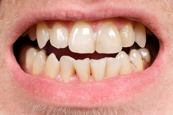 Teeth with tartar and caries, crooked lower foreground incisors, close-up
