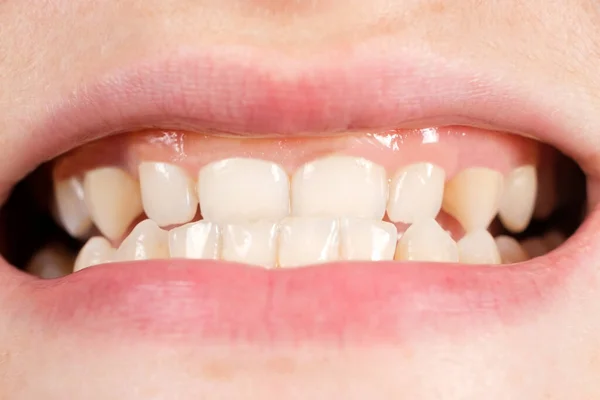 Patient with gingival smile, large gums and small teeth, microdentia, close-up — Fotografia de Stock