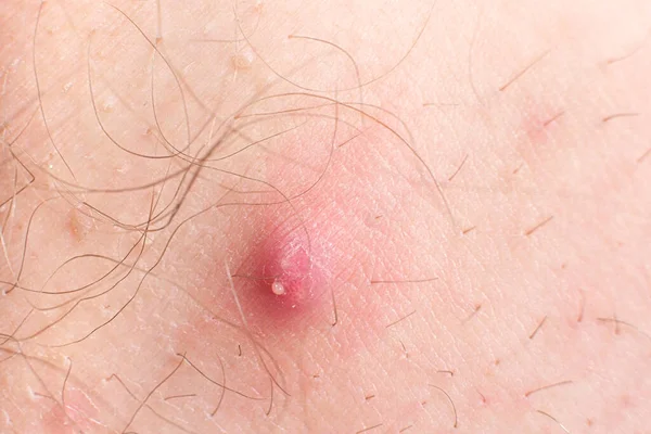 Macro photo of a large red pimple with the release of pus on human skin — Stock Photo, Image