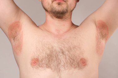 Koltuk altlarının kızarıklığı - iltihap ya da dikenli ısı, koltukaltlarında kırmızı lekeler.