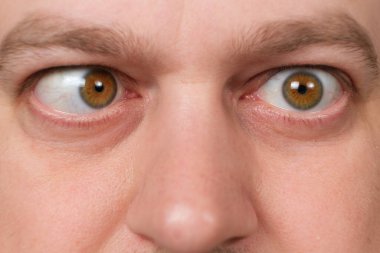 A man with strabismus squints his eyes on a white background
