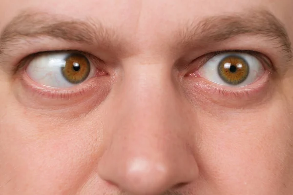 Man Strabismus Squints His Eyes White Background — Fotografia de Stock