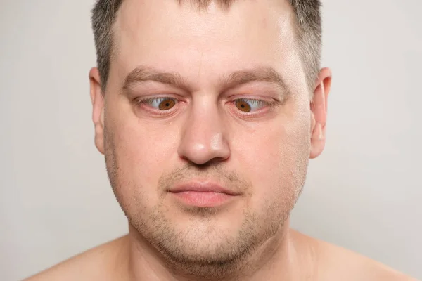 Man Does Exercises Eyes Looks Nose Brings His Eyes Center — Photo