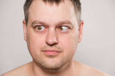 A man with strabismus squints his eyes on a white background