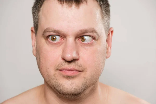 Man Strabismus Squints His Eyes White Background — Foto Stock