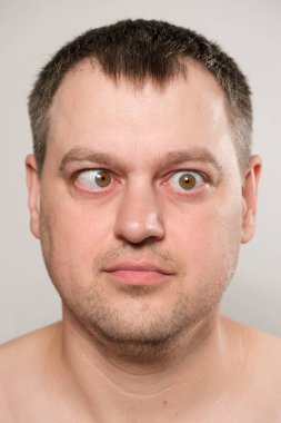 A man with strabismus squints his eyes on a white background