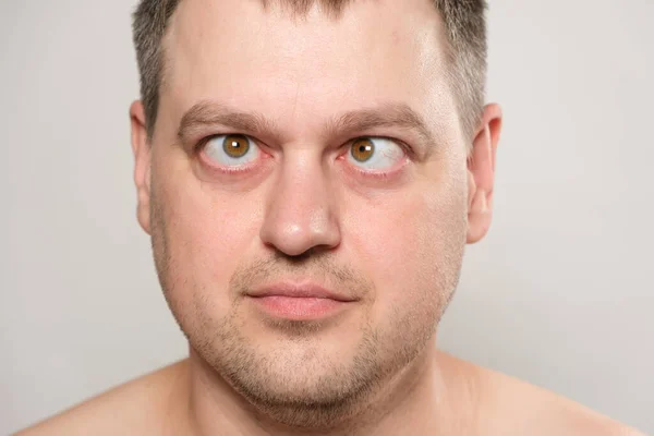 Strabismus Şaşı Bir Adam Gözlerini Beyaz Bir Arkaplana Dikti — Stok fotoğraf