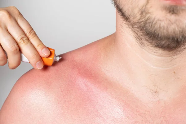 Applying Therapeutic Ointment Skin Person Sunburn Close — Stock Photo, Image