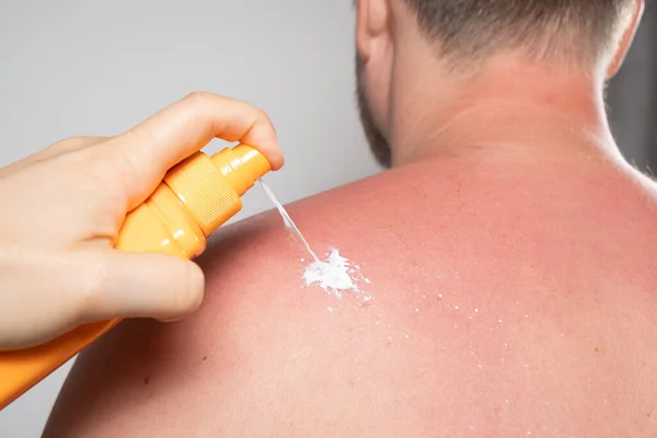 Applying Sunscreen Therapeutic Spray Skin Man Sunburn —  Fotos de Stock