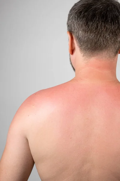 Back of a man with a sunburn, close-up