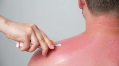 Applying therapeutic ointment to the skin of a person with a sunburn, close-up