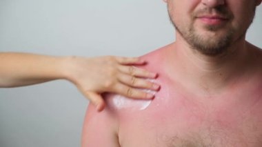 The process of applying a therapeutic cream to a sunburn on the skin of a man