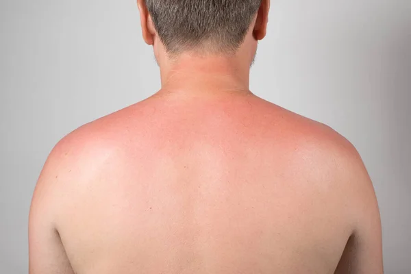 Back of a man with a sunburn, close-up