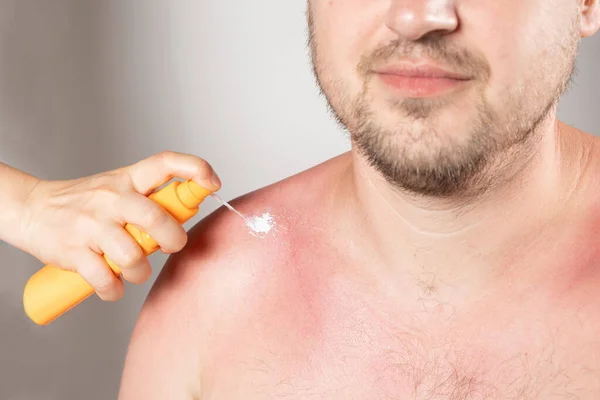 Applying sunscreen or therapeutic spray to the skin of a man with a sunburn.