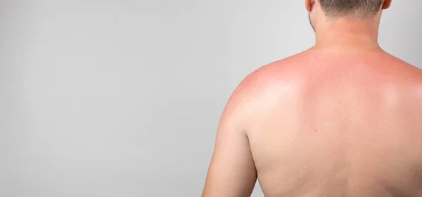 Back Man Sunburn Close Banner Space Text Gray — Stock Photo, Image