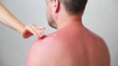 Applying therapeutic ointment to the skin of a person with a sunburn, close-up