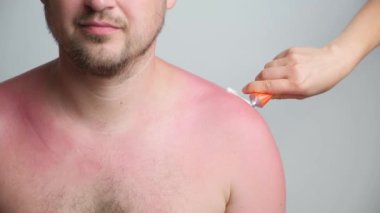 Applying therapeutic ointment to the skin of a person with a sunburn, close-up