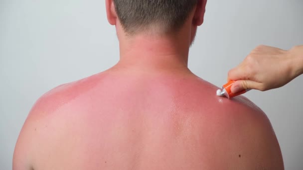 Applying Therapeutic Ointment Skin Person Sunburn Close — Stock Video