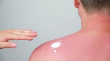 The process of applying a therapeutic cream to a sunburn on the skin of a man