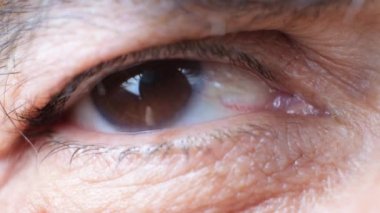 Eye of an elderly man with cataracts, clouding of the lens, macro video