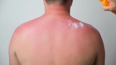 The process of applying a therapeutic cream to a sunburn on the skin of a man
