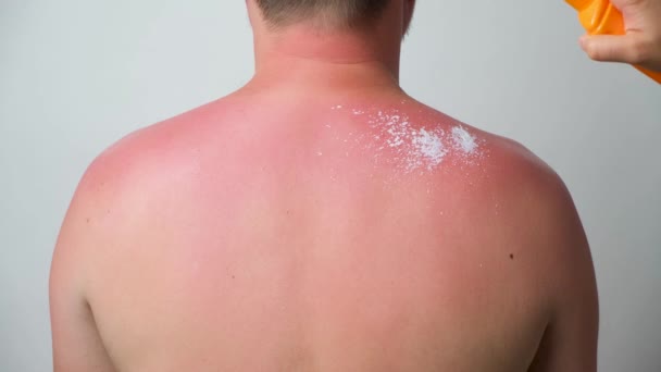 Process Applying Therapeutic Cream Sunburn Skin Man — 图库视频影像