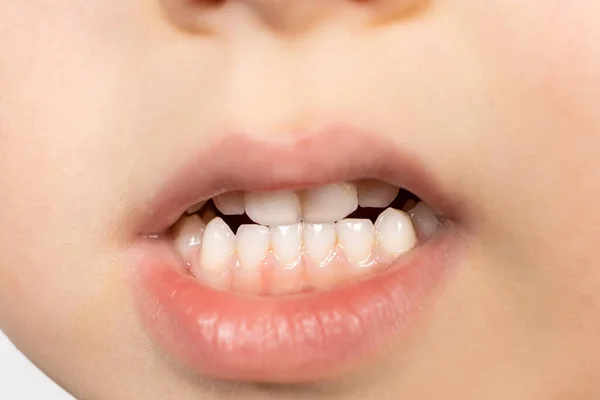 Milchzähne Eines Fünfjährigen Kindes Biss Belag Auf Den Zähnen Hygiene — Stockfoto