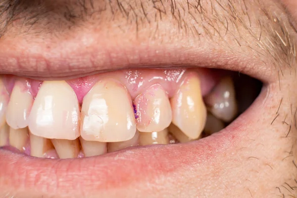 Plaque Auf Menschlichen Zähnen Ist Mit Indikatortabletten Rosa Gefärbt — Stockfoto