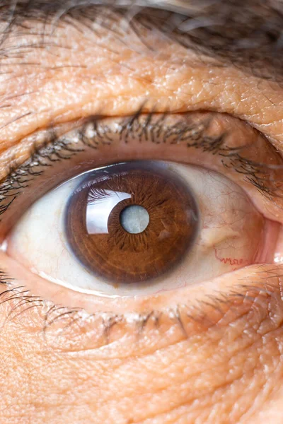 Olho Homem Idoso Com Catarata Turvação Lente Macro — Fotografia de Stock