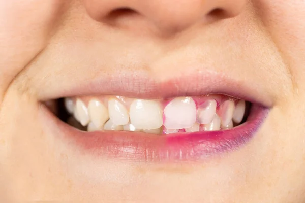 Dentes Uma Mulher Antes Depois Usar Pílulas Indicadoras Para Determinar — Fotografia de Stock