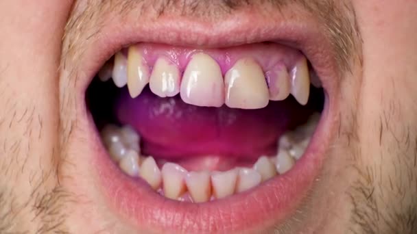 Placa Los Dientes Humanos Color Rosa Con Tabletas Indicadoras — Vídeo de stock