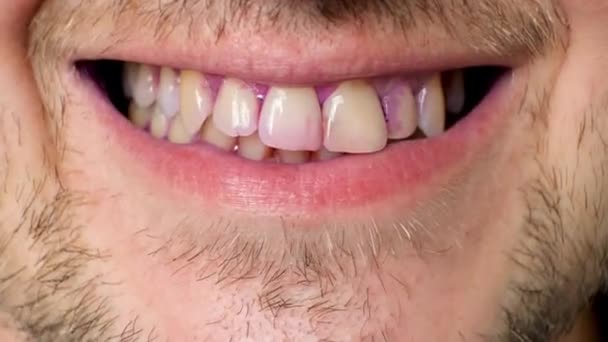 Placa Los Dientes Humanos Color Rosa Con Tabletas Indicadoras — Vídeo de stock