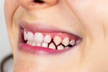 İnsan dişlerindeki plaket, gösterge tabletleriyle pembeye boyanmış.