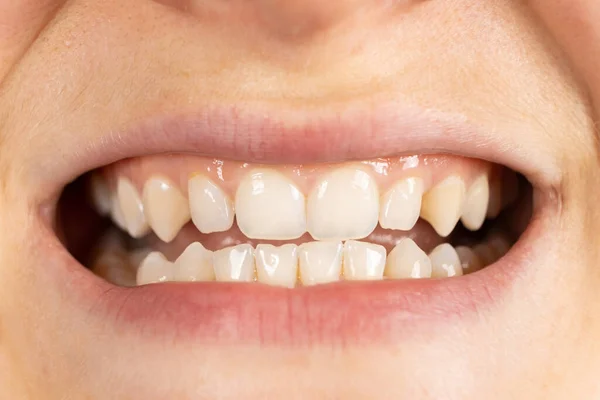 Paciente Com Oclusão Lacuna Entre Dentes Superiores Inferiores Boca Close — Fotografia de Stock