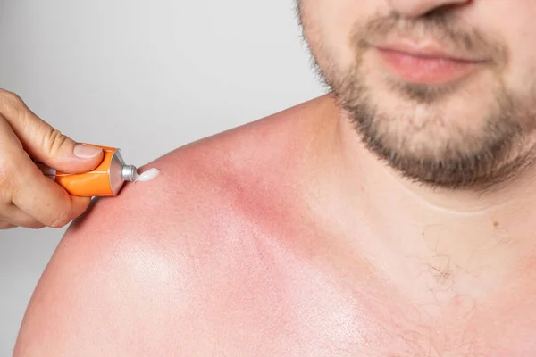 stock image Applying therapeutic ointment to the skin of a person with a sunburn, close-up