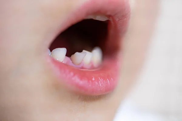 Close Dentes Leite Frente Criança Balançada — Fotografia de Stock
