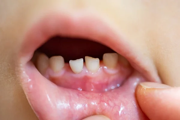 Close Dentes Leite Frente Criança Balançada — Fotografia de Stock